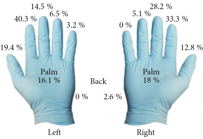 Частота возникновения микроперфораций хирургических перчаток зависит от длительности ношения